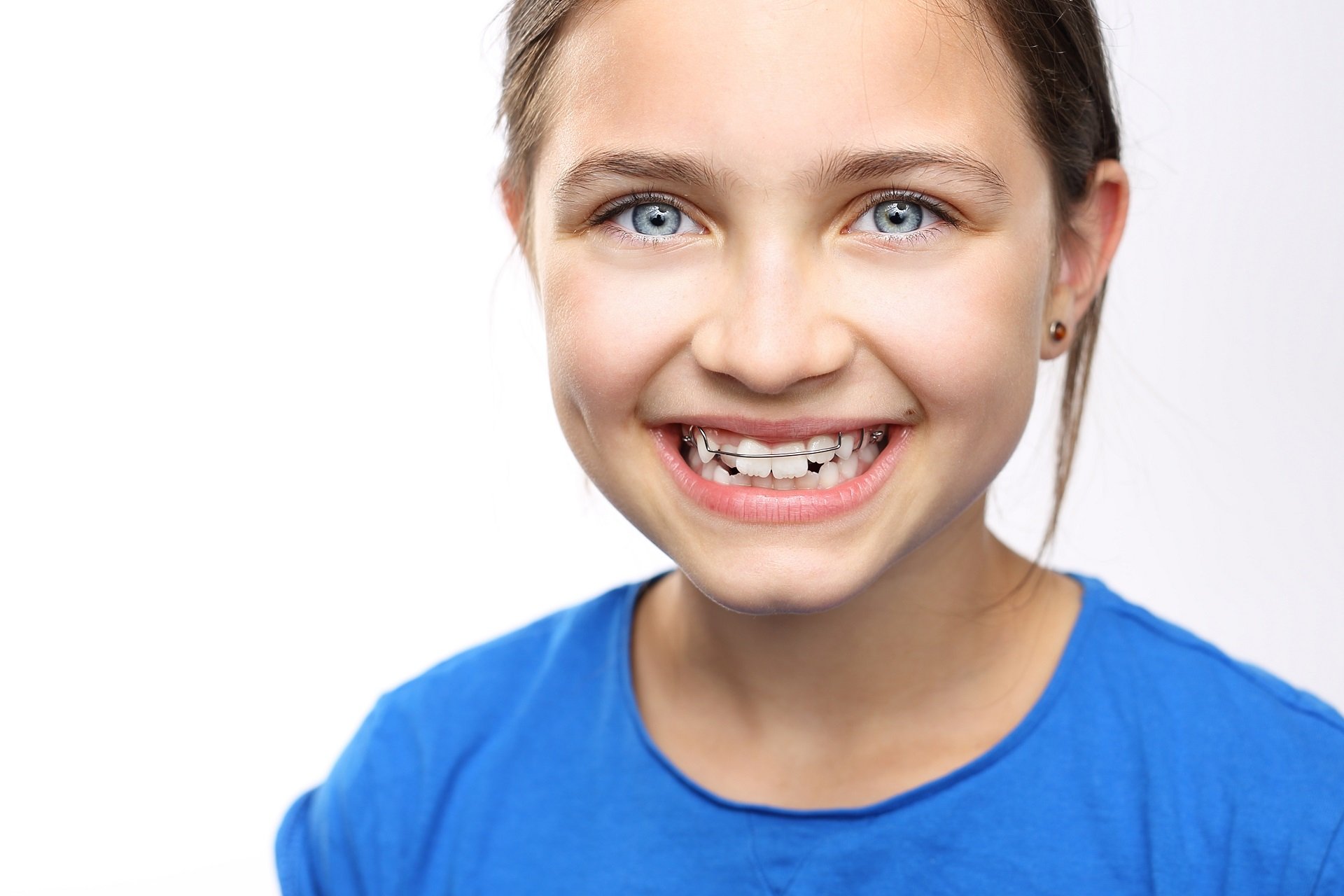 Do All Your Baby Teeth Need To Fall Out Before You Get Braces? 